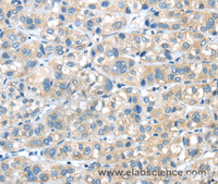 Immunohistochemistry of paraffin-embedded Human liver cancer tissue using PLXNA2 Polyclonal Antibody at dilution 1:40