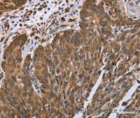 Immunohistochemistry of paraffin-embedded Human lung cancer tissue using PLXNB1 Polyclonal Antibody at dilution 1:40