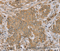 Immunohistochemistry of paraffin-embedded Human cervical cancer tissue using RNF148 Polyclonal Antibody at dilution 1:45