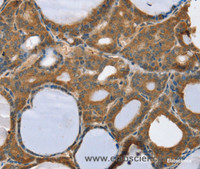 Immunohistochemistry of paraffin-embedded Human thyroid cancer using TRIM3 Polyclonal Antibody at dilution of 1:45