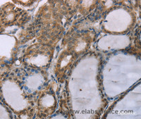 Immunohistochemistry of paraffin-embedded Human thyroid cancer using ACTN2 Polyclonal Antibody at dilution of 1:30