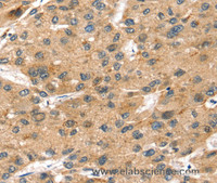 Immunohistochemistry of paraffin-embedded Human liver cancer using SORT1 Polyclonal Antibody at dilution of 1:35