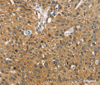 Immunohistochemistry of paraffin-embedded Human breast cancer using SORT1 Polyclonal Antibody at dilution of 1:35