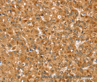 Immunohistochemistry of paraffin-embedded Human liver cancer using STX3 Polyclonal Antibody at dilution of 1:35