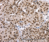 Immunohistochemistry of paraffin-embedded Human breast cancer using TAF15 Polyclonal Antibody at dilution of 1:35