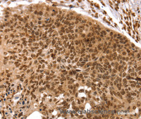 Immunohistochemistry of paraffin-embedded Human esophagus cancer using TAF10 Polyclonal Antibody at dilution of 1:35