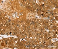 Immunohistochemistry of paraffin-embedded Human breast cancer using TBC1D4 Polyclonal Antibody at dilution of 1:40