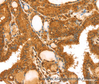 Immunohistochemistry of paraffin-embedded Human thyroid cancer tissue using TRIM25 Polyclonal Antibody at dilution 1:40