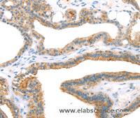 Immunohistochemistry of paraffin-embedded Human thyroid cancer using TNIP2 Polyclonal Antibody at dilution of 1:35