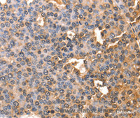 Immunohistochemistry of paraffin-embedded Human liver cancer using AFP Polyclonal Antibody at dilution of 1:60