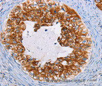 Immunohistochemistry of paraffin-embedded Human cervical cancer using CK-13 Polyclonal Antibody at dilution of 1:35