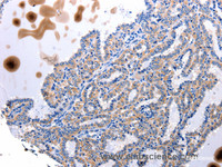 Immunohistochemistry of paraffin-embedded Human thyroid cancer tissue using UTS2 Polyclonal Antibody at dilution 1:100