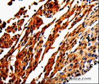 Immunohistochemistry of paraffin-embedded Human cervical cancer tissue using ADD1 Polyclonal Antibody at dilution 1:50