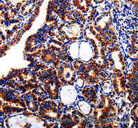 Immunohistochemistry of paraffin-embedded Human thyroid cancer using AFP Polyclonal Antibody at dilution of 1:40