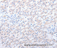 Immunohistochemistry of paraffin-embedded Human liver cancer using ALDH1A1/2/3 Polyclonal Antibody at dilution of 1:40