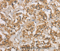 Immunohistochemistry of paraffin-embedded Human thyroid cancer using CASP3 Polyclonal Antibody at dilution of 1:30