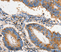 Immunohistochemistry of paraffin-embedded Human colon cancer using FAS Polyclonal Antibody at dilution of 1:60