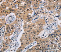 Immunohistochemistry of paraffin-embedded Human lung cancer using TLR3 Polyclonal Antibody at dilution of 1:50
