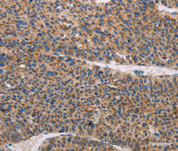 Immunohistochemistry of paraffin-embedded Human liver cancer tissue using TLR8 Polyclonal Antibody at dilution 1:30