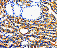 Immunohistochemistry of paraffin-embedded Human thyroid cancer using AIMP2 Polyclonal Antibody at dilution of 1:50