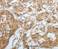 Immunohistochemistry of paraffin-embedded Human lung cancer using Amphiphysin I Polyclonal Antibody at dilution of 1:30