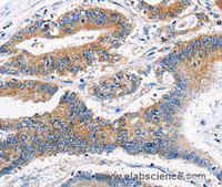 Immunohistochemistry of paraffin-embedded Human colon cancer tissue using APLNR Polyclonal Antibody at dilution 1:40
