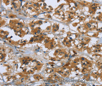 Immunohistochemistry of paraffin-embedded Human thyroid cancer using RAP1B Polyclonal Antibody at dilution of 1:50