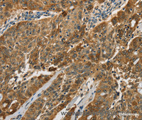 Immunohistochemistry of paraffin-embedded Human ovarian cancer using Cathepsin E Polyclonal Antibody at dilution of 1:50