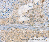 Immunohistochemistry of paraffin-embedded Human cervical cancer tissue using CDC27 Polyclonal Antibody at dilution 1:50