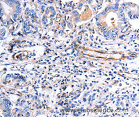 Immunohistochemistry of paraffin-embedded Human stomach cancer using COX11 Polyclonal Antibody at dilution of 1:30