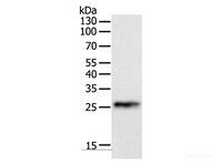 Western Blot analysis of Human liver cancer tissue using CRP Polyclonal Antibody at dilution of 1:800