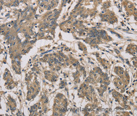 Immunohistochemistry of paraffin-embedded Human colon cancer using CYCS Polyclonal Antibody at dilution of 1:70