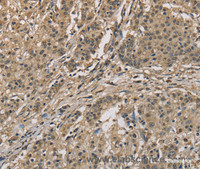 Immunohistochemistry of paraffin-embedded Human gastric cancer using CYCS Polyclonal Antibody at dilution of 1:70