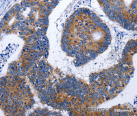 Immunohistochemistry of paraffin-embedded Human colon cancer using EEF1 gamma Polyclonal Antibody at dilution of 1:50