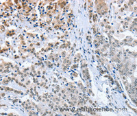 Immunohistochemistry of paraffin-embedded Human prostate cancer using ELAVL1 Polyclonal Antibody at dilution of 1:50