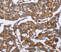 Immunohistochemistry of paraffin-embedded Human breast cancer tissue using ENPP5 Polyclonal Antibody at dilution 1:60