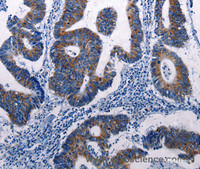 Immunohistochemistry of paraffin-embedded Human colon cancer tissue using MKP-3 Polyclonal Antibody at dilution 1:50