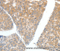 Immunohistochemistry of paraffin-embedded Human liver cancer tissue using FSHR Polyclonal Antibody at dilution 1:70