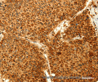 Immunohistochemistry of paraffin-embedded Human liver cancer tissue using GRM3 Polyclonal Antibody at dilution 1:50