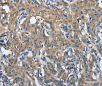 Immunohistochemistry of paraffin-embedded Human gastric cancer tissue using SCARB1 Polyclonal Antibody at dilution 1:65