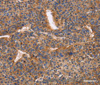 Immunohistochemistry of paraffin-embedded Human liver cancer using ITGB1 Polyclonal Antibody at dilution of 1:50