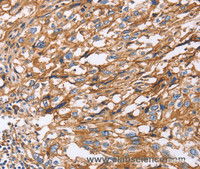 Immunohistochemistry of paraffin-embedded Human esophagus cancer using ITGB1 Polyclonal Antibody at dilution of 1:50