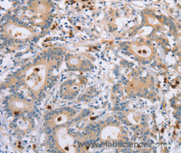 Immunohistochemistry of paraffin-embedded Human colon cancer tissue using KLK4 Polyclonal Antibody at dilution 1:40