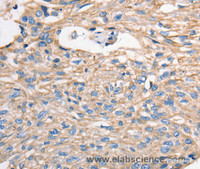 Immunohistochemistry of paraffin-embedded Human esophagus cancer using MVP Polyclonal Antibody at dilution of 1:40