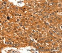 Immunohistochemistry of paraffin-embedded Human esophagus cancer using SERPINB5 Polyclonal Antibody at dilution of 1:60