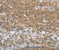 Immunohistochemistry of paraffin-embedded Human cervical cancer tissue using MLH1 Polyclonal Antibody at dilution 1:60