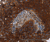Immunohistochemistry of paraffin-embedded Human cervical cancer tissue using MSLN Polyclonal Antibody at dilution 1:40