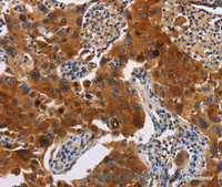 Immunohistochemistry of paraffin-embedded Human lung cancer tissue using MSLN Polyclonal Antibody at dilution 1:40