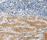 Immunohistochemistry of paraffin-embedded Human liver cancer using MUC20 Polyclonal Antibody at dilution of 1:40