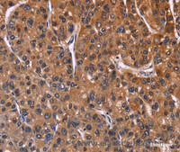 Immunohistochemistry of paraffin-embedded Human liver cancer tissue using NFATC3 Polyclonal Antibody at dilution 1:60